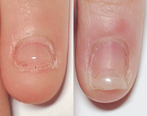 深爪・噛み爪・爪が薄くても・長持ちパーフェクトフィルインのジェルネイル一層ベース残しは6週間持つ　　一層　を　残した　爪切りで切れるジェルネイル